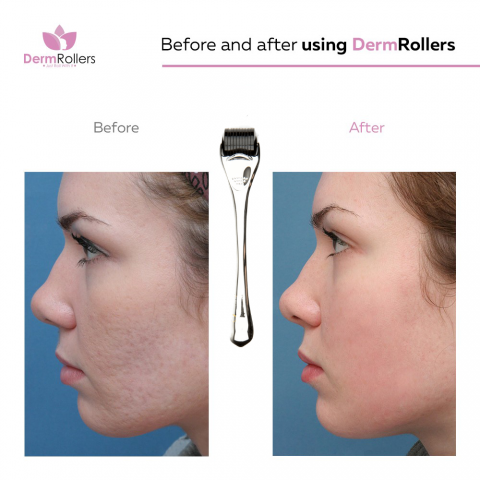 dermroller 2